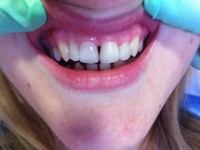 Composite veeners