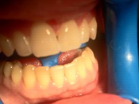 Teeth whitening