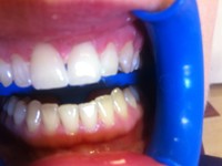Teeth whitening