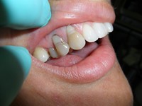 Internal bleaching