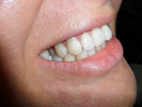 Internal bleaching
