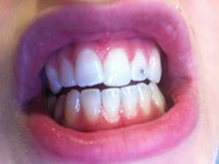 Dental jewelry